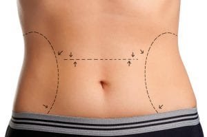 Recuperação da Abdominoplastia